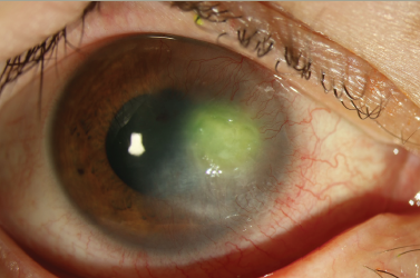 A Comprehensive Review of Acanthamoeba Keratitis: Insights and Innovations