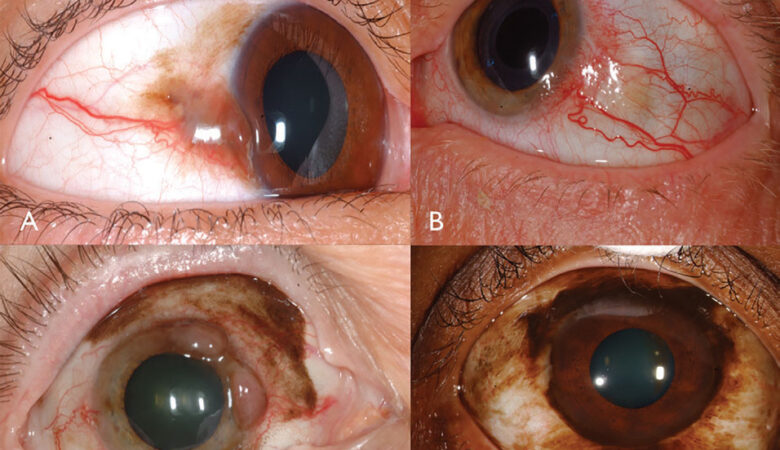 Navigating Pigmented Conjunctival Lesions: Understanding Primary Acquired Melanosis (PAM)