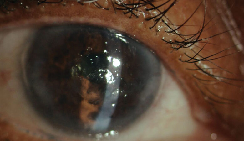 Nurturing the Cornea: Insights into Neurotrophic Keratopathy