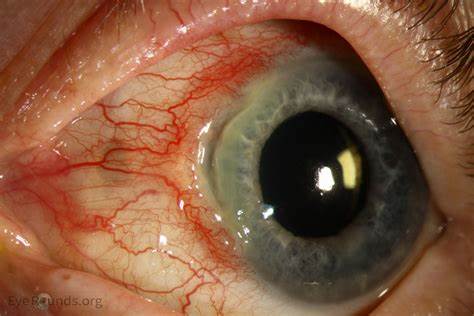 Unraveling Peripheral Ulcerative Keratitis (PUK): Insights into Diagnosis and Management