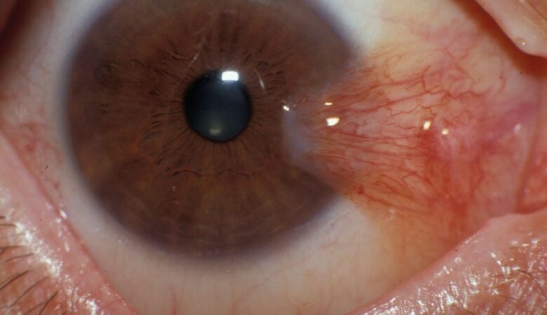 Understanding Pterygium: A Comprehensive Guide to Diagnosis and Management