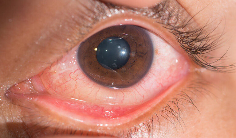 Demystifying Chlamydial Conjunctivitis: A Comprehensive Overview