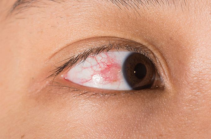 Demystifying Episcleritis: Understanding Causes, Symptoms, and Treatment