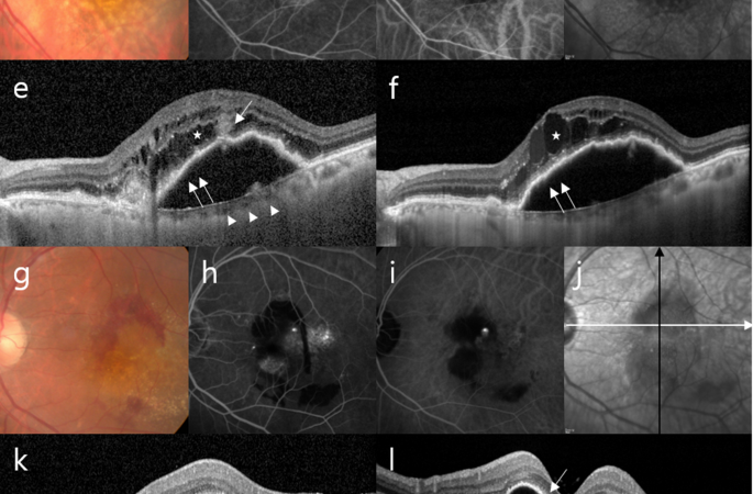 Retinal Angiomatous Proliferation (RAM): A Comprehensive Overview