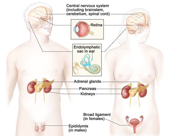 Understanding Von Hippel-Lindau (VHL) Disease: A Comprehensive Overview