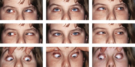 Unraveling Strabismus: Alphabet Patterns