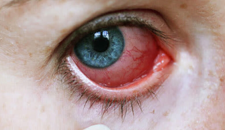 Anterior Uveitis Syndromes: A Comprehensive Review