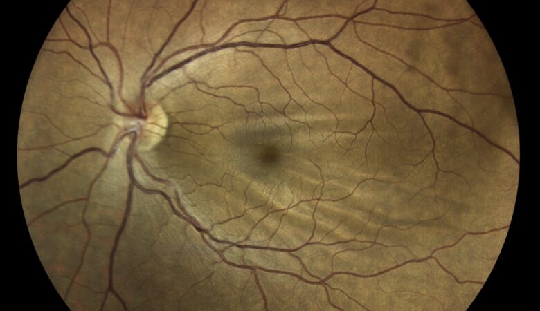 Unraveling Choroidal Folds: Insights into Diagnosis and Management