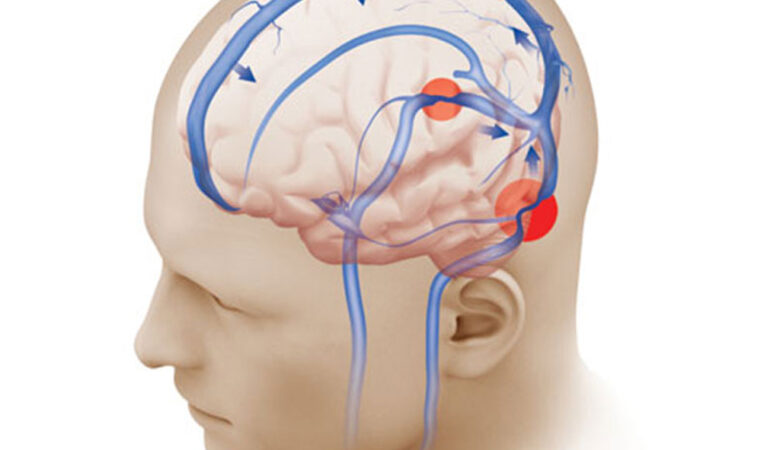 Unraveling Idiopathic Intracranial Hypertension: Insights into Pathogenesis, Clinical Features, Diagnosis, Management, and Recent Advances