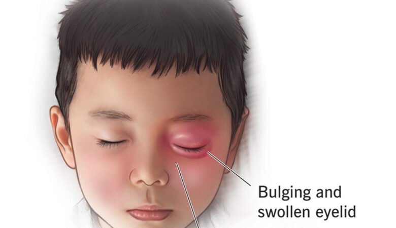 Understanding Orbital Cellulitis: A Comprehensive Review