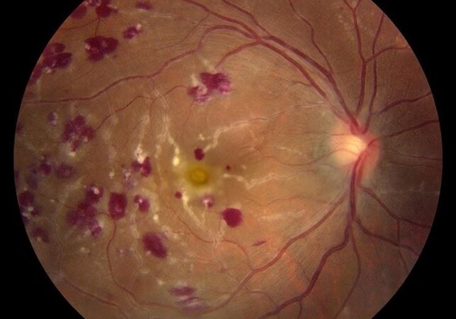 Retinal Vasculitis: Understanding the Inflammatory Disorder of the Retinal Vasculature