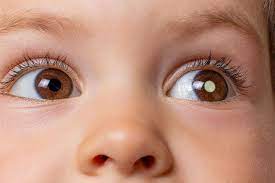 Unveiling Retinoblastoma: Insights and Advancements