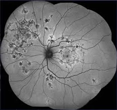 Exploring White Dot Syndromes: An In-Depth Analysis