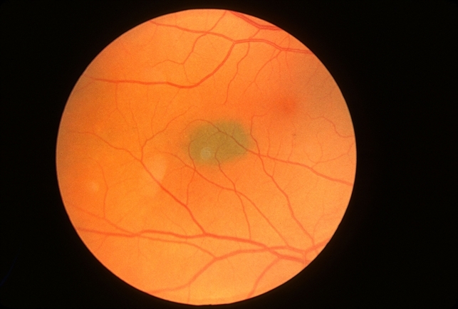 Understanding Choroidal Nevi: A Comprehensive Overview