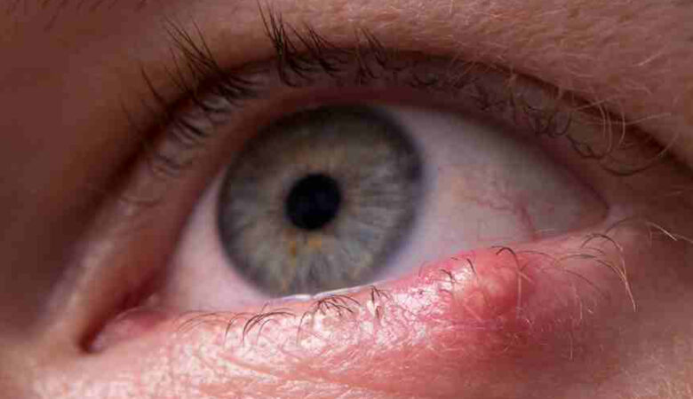 Understanding Malignant Tumors of the Eyelids: A Comprehensive Review