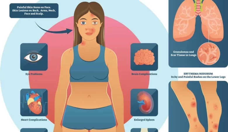 Exploring Sarcoidosis: Understanding a Multisystem Disorder