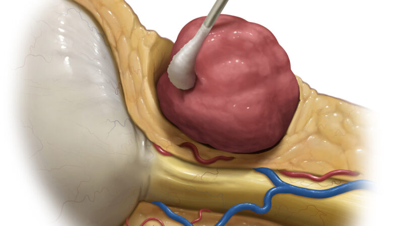 Insights into Orbital Tumors: Vascular Lesions